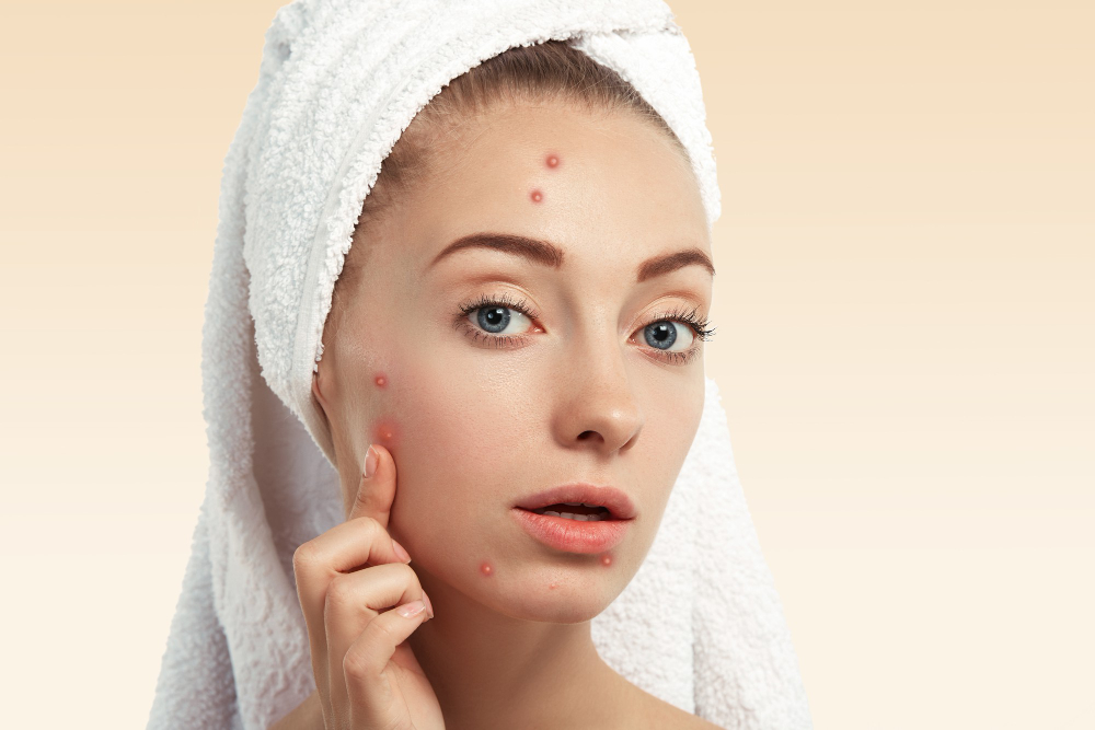 best anti-acne ingredient science Singapore, dermatologist-recommended clear skin, clinical skincare Singapore 2025, science-backed acne solutions Singapore